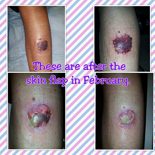 Mohs progression