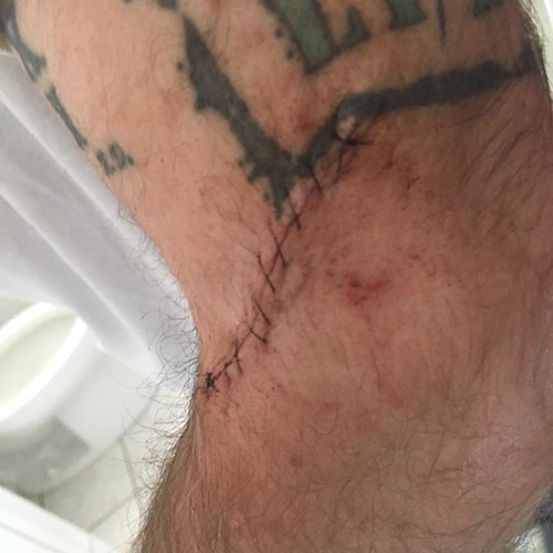 Mohs surgery wound with stiches above elbow