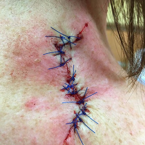 Large red wound on back with black stitches from mohs surgery