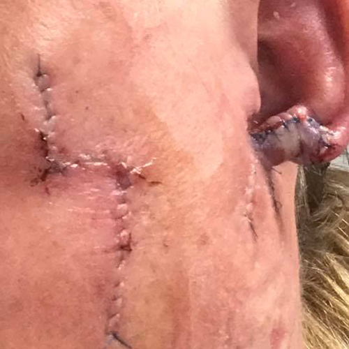 Mohs surgery wound on ear and cheek