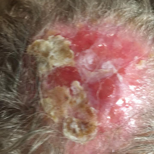 Mohs scalp