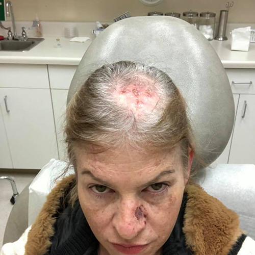 Mohs scalp 2