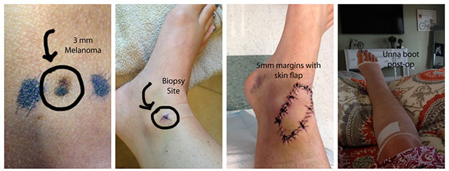 Tracy's ankle treatment