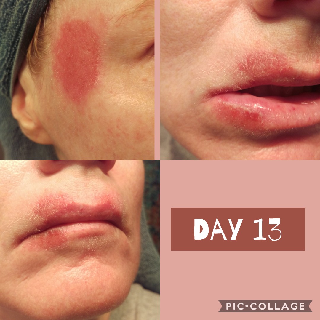 Day 13 of Efudex treatment around mouth