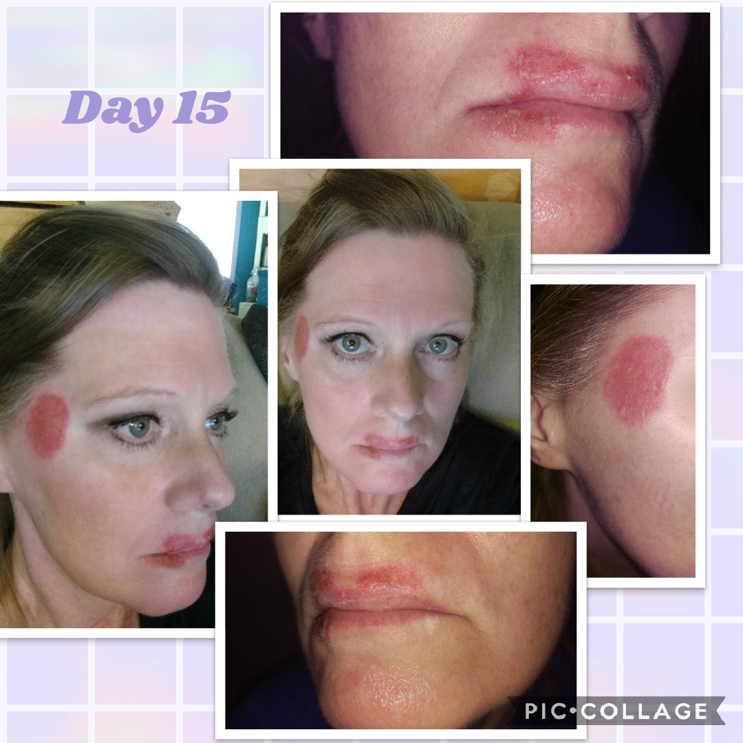 Invasix Treatment Before After One