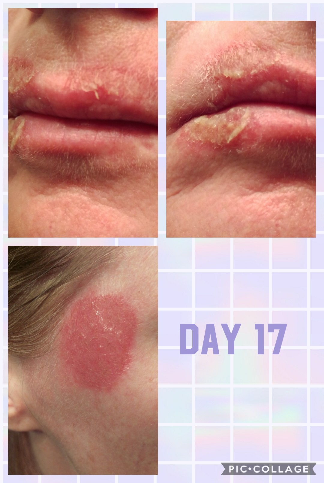 Day 17 of Efudex treatment around mouth