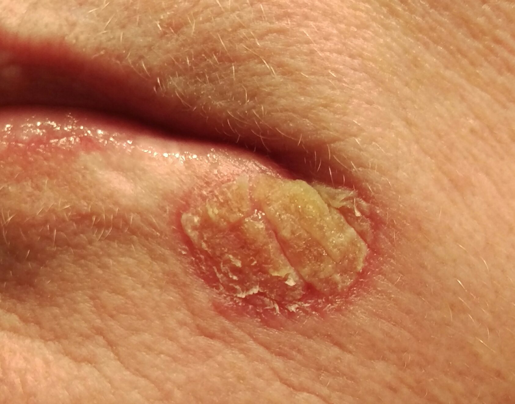 Cracking lip after Efudex treatment