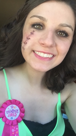 A smiling girl with a prominent scar on her cheek