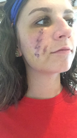 A girl with her face turned so you can see a purple scar