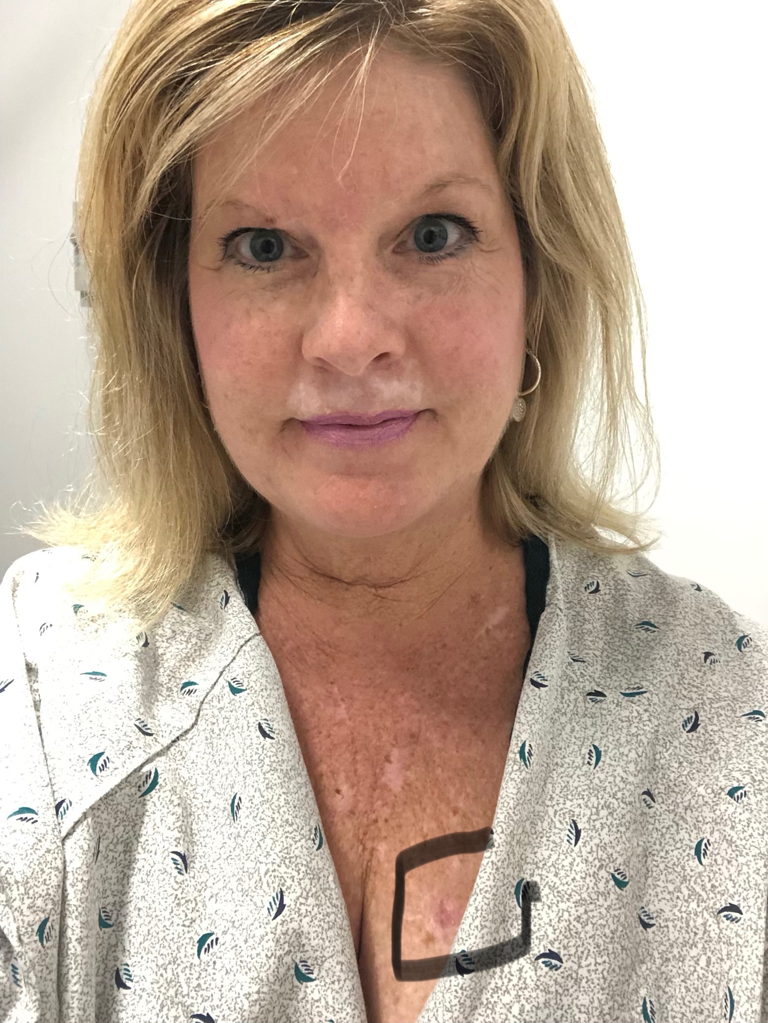 Judy with a basal cell carcinoma on her chest