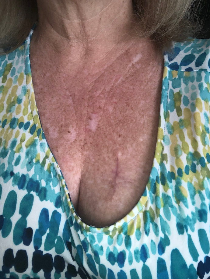 A scar on Judy's chest after her stitches were removed
