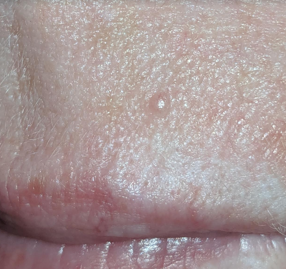 suspicious-spot-on-my-lip-part-1-skincancer