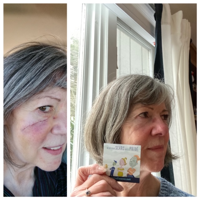 Woman with scar on cheek holds up magnet saying wear your scars with pride