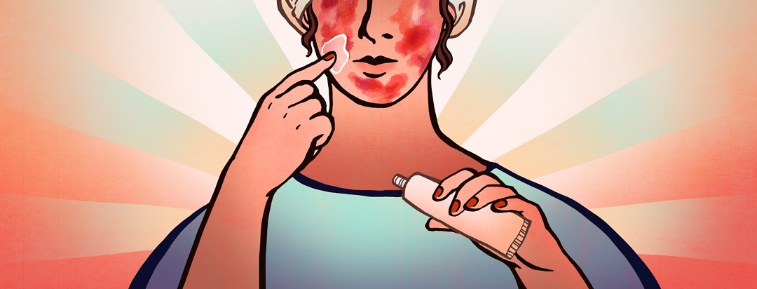 A woman applies Efudex to her face. Her skin is raw and red due to its side effects.