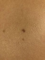 back mole