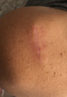Excision scar