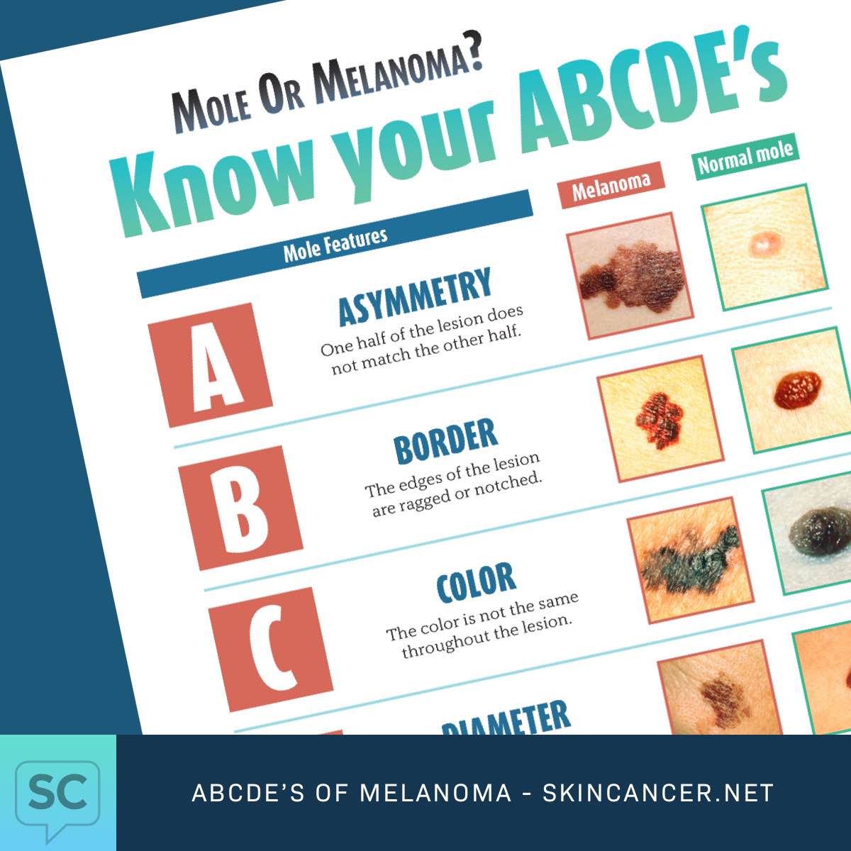 The ABCDE's of Melanoma Chart.