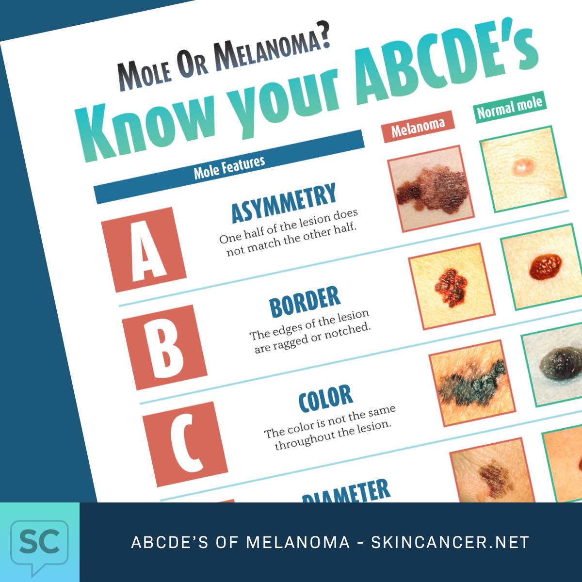 What Is Melanoma Learn The Abcde Of Moles Ng 4752