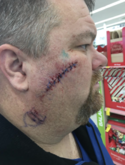 mike hyder community member stitches on face
