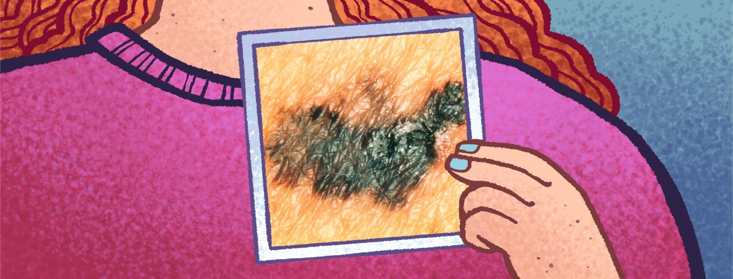 A person holds up a photo of a cancerous mole.