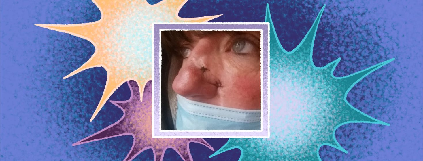 A photo of a woman's skin cancer scars on her nose.