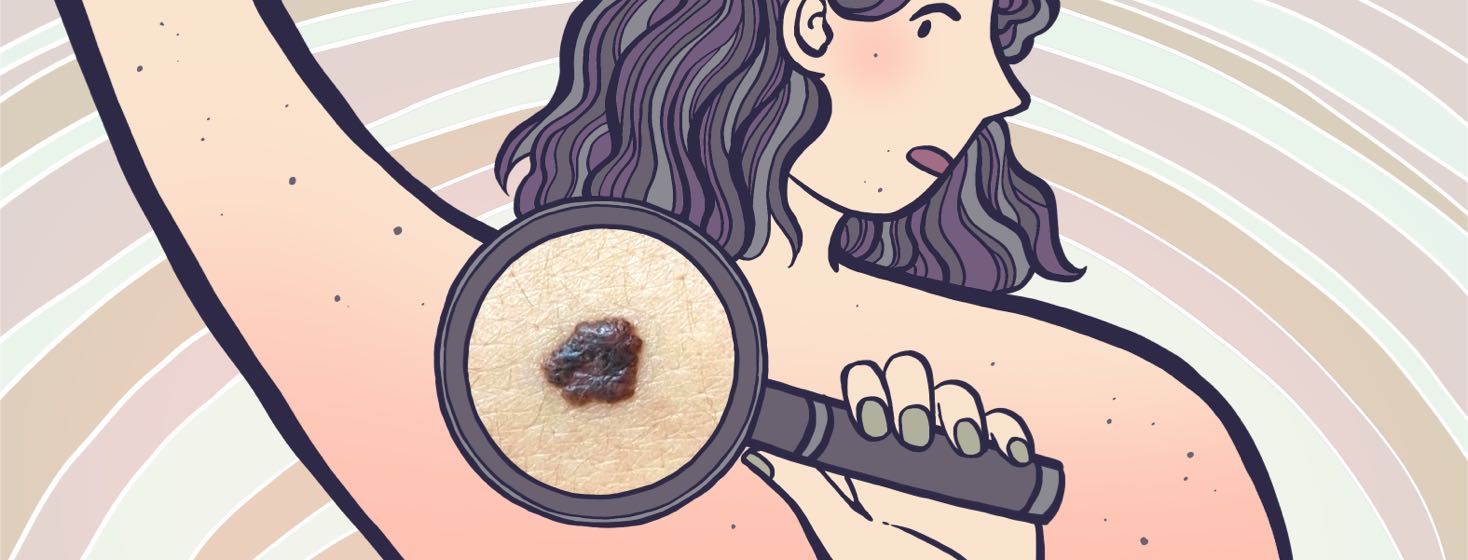 How to Perform an At-Home Skin Cancer Self-Examination image