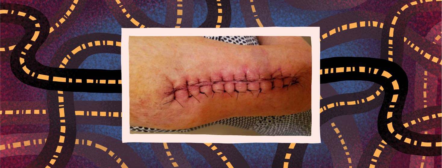 A photo of a post-surgery wound.