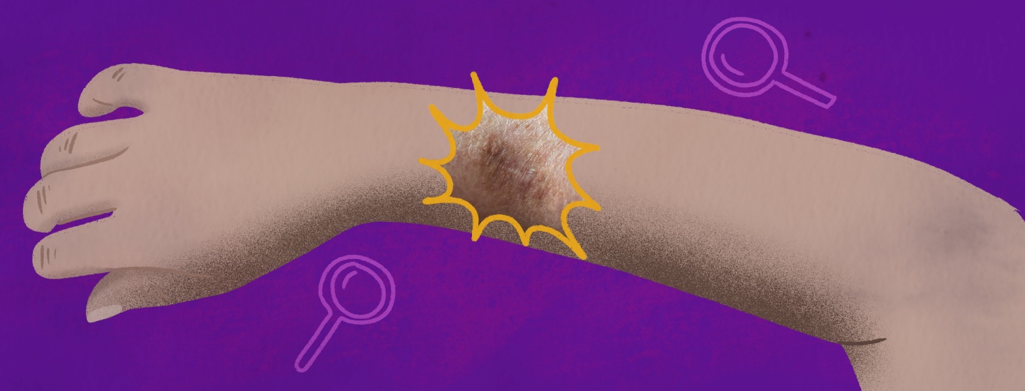 Psst...Is It Time for Your Skin Cancer Self-Exam? image