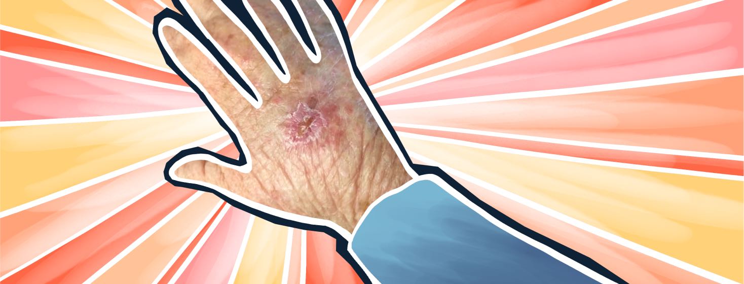 A hand in front of sun rays shows a photo of actinic keratosis.