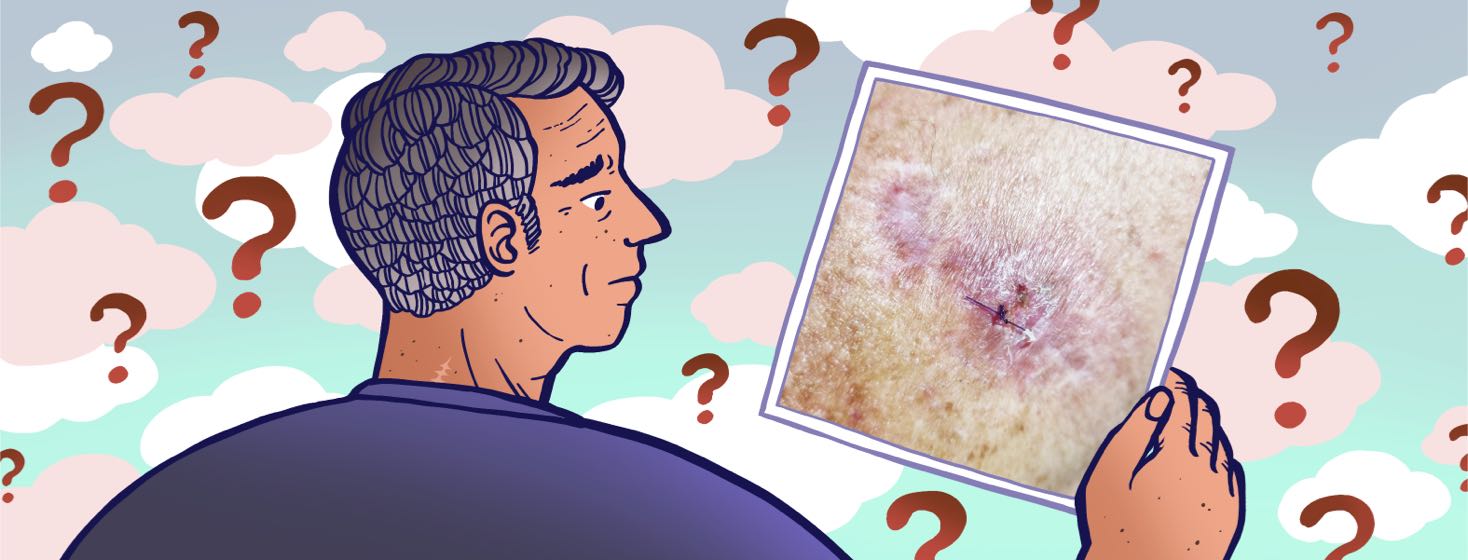 A man with a worried expression holds a photo of a cancerous spot on the skin.
