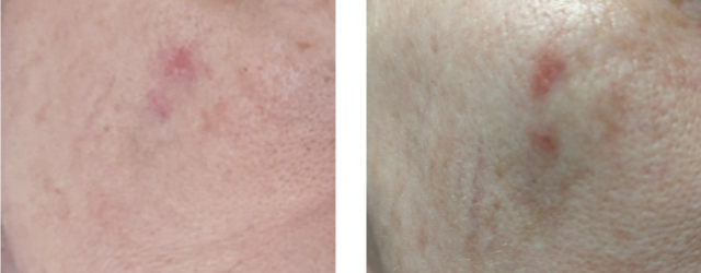 Photo of a skin cancer spot on day 1 of cryotherapy, followed by the same spot on day 4.